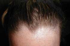 hair-replacement_clip_image001